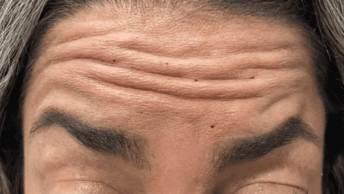 Forehead Lines HIFU