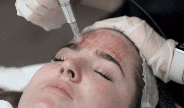 Vampire Facial (PRP + Microneedling) 10 Vampire Facial (PRP + Microneedling)