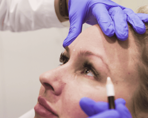 Botox – Forehead Lines (Frontalis Muscle)