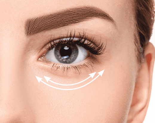 Botox – Fox Eyes (Eyebrow Lift)