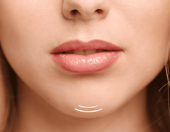 Botox – Orange Peel (Dimpled Chin)