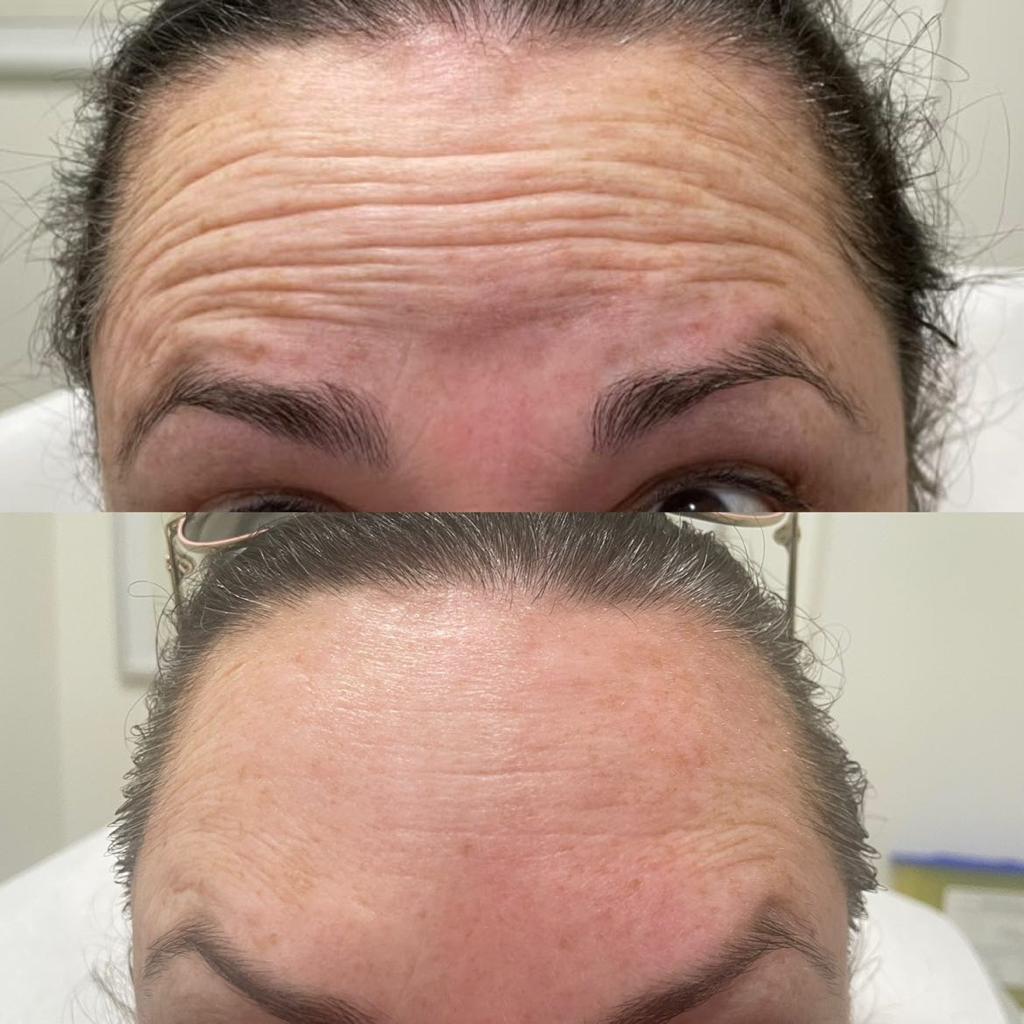 botox forehead lines