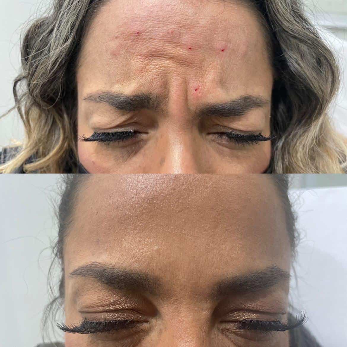 botox frontalis - forehead lines (1)