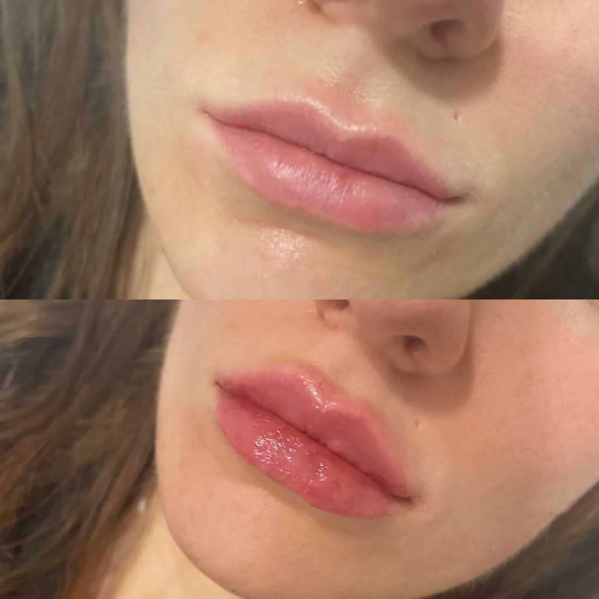 lip filler