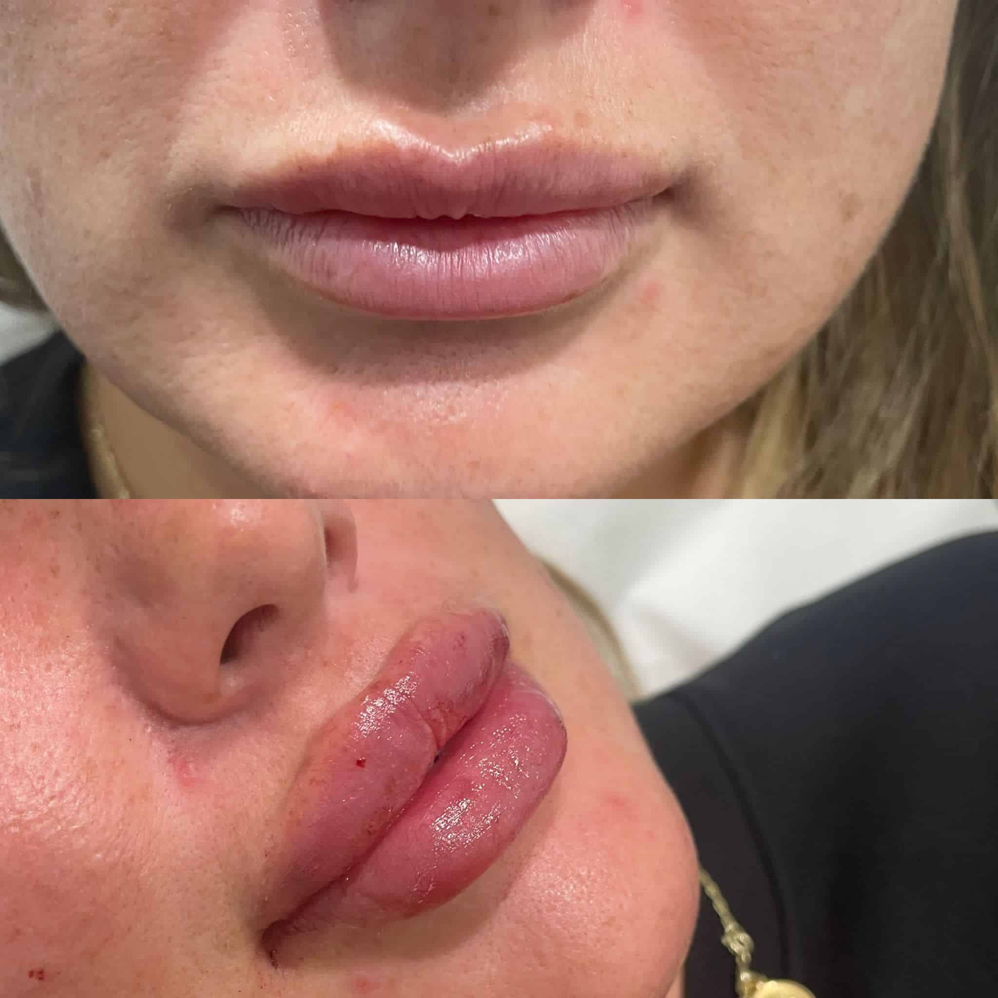 Lip Augmentation with Fillers