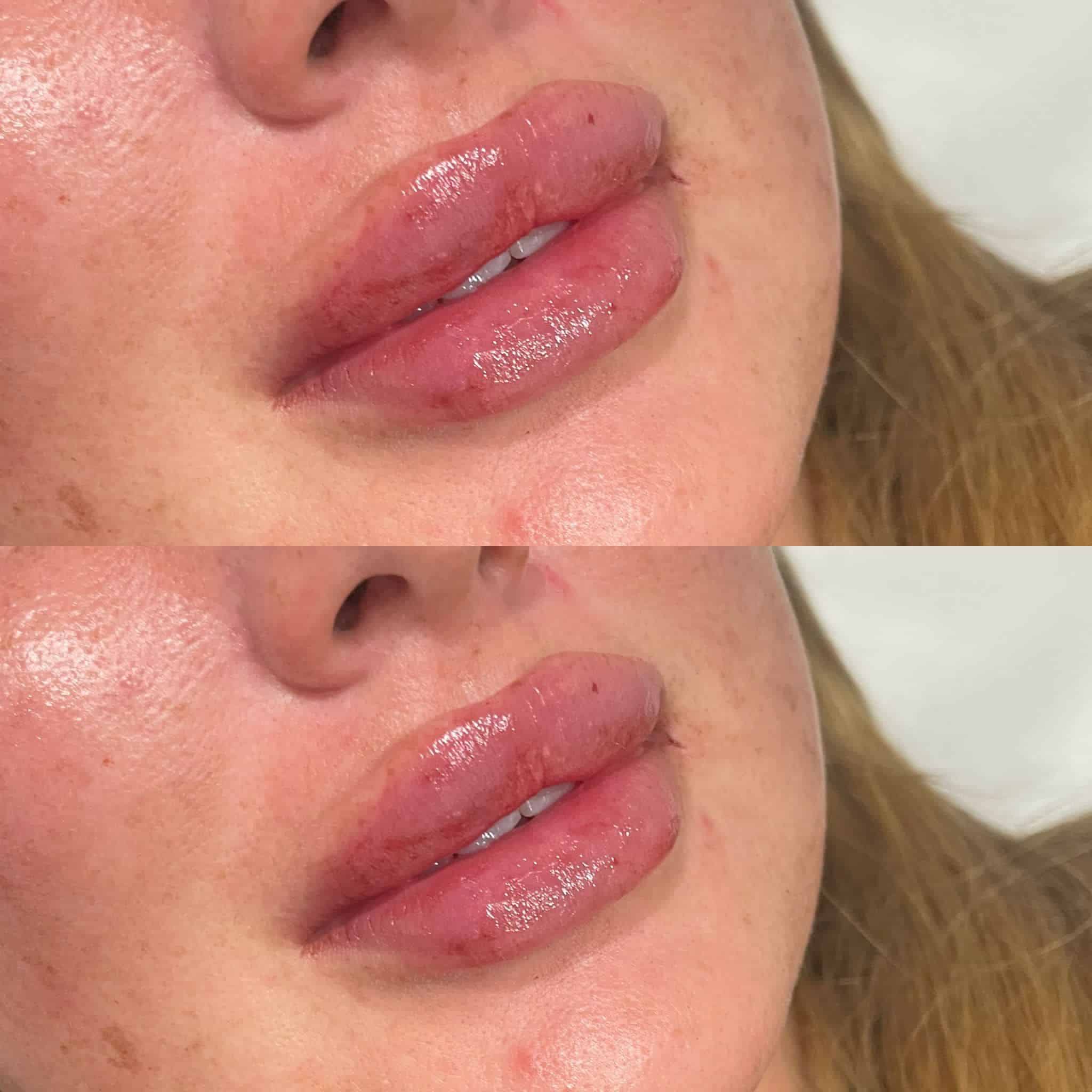 Lip Augmentation with Fillers