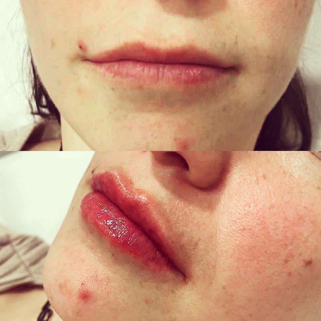 Lip Augmentation with Fillers