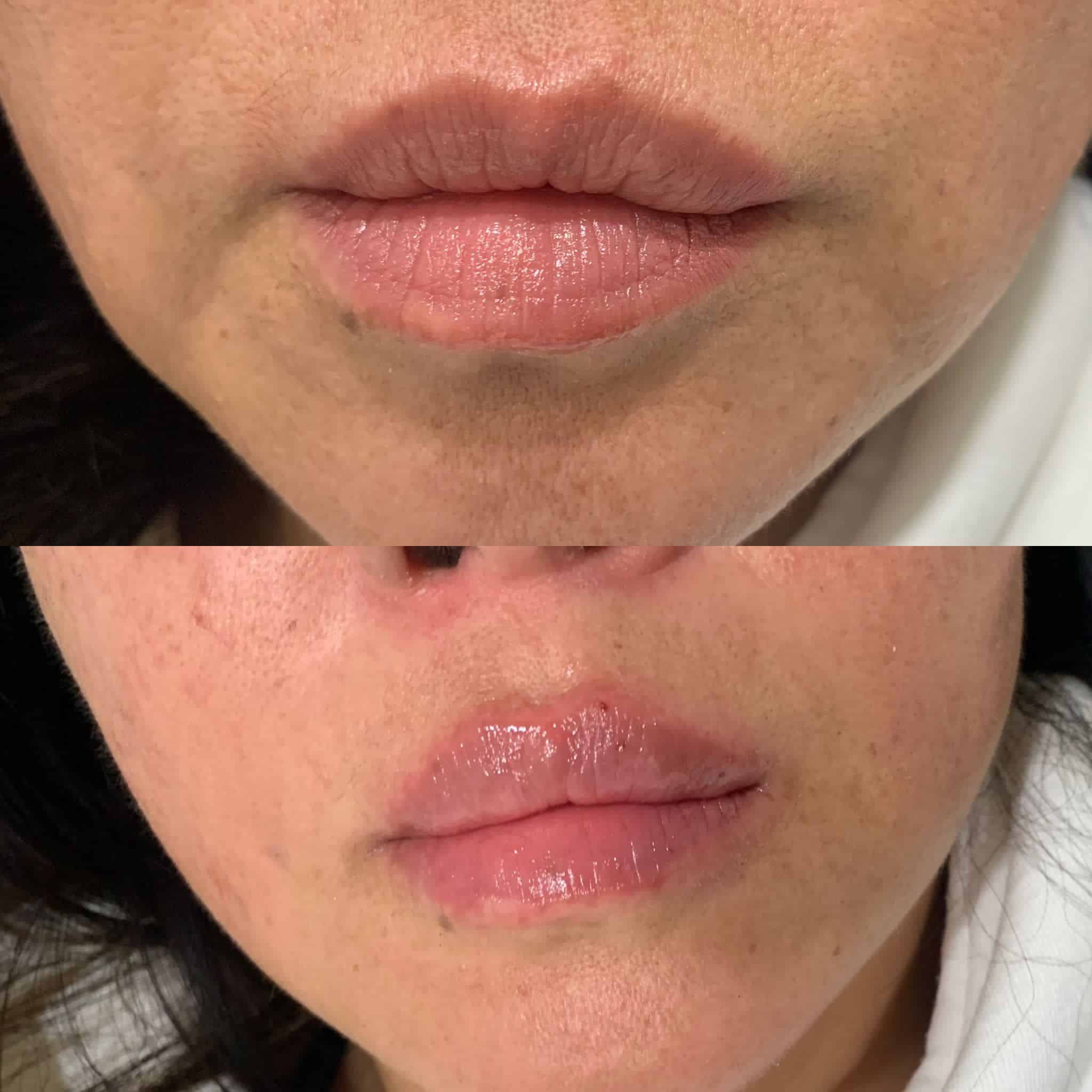 Lip Augmentation with Fillers