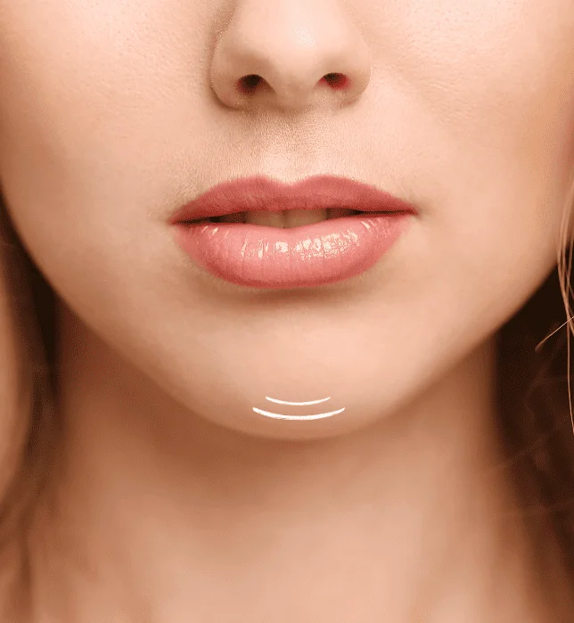 Belkyra Double Chin Removal – Single Treatment