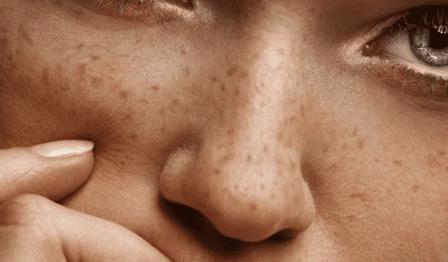 Freckles Phototherapy