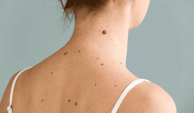 Skin Tag And Mole Removal 1 To 5 Tags And Moles
