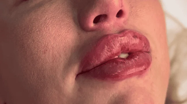 Loran Strips Baby Doll Lips – Lip Taping Lip Filler