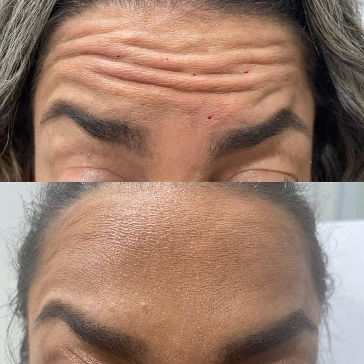 forehead lines - frontalis botox