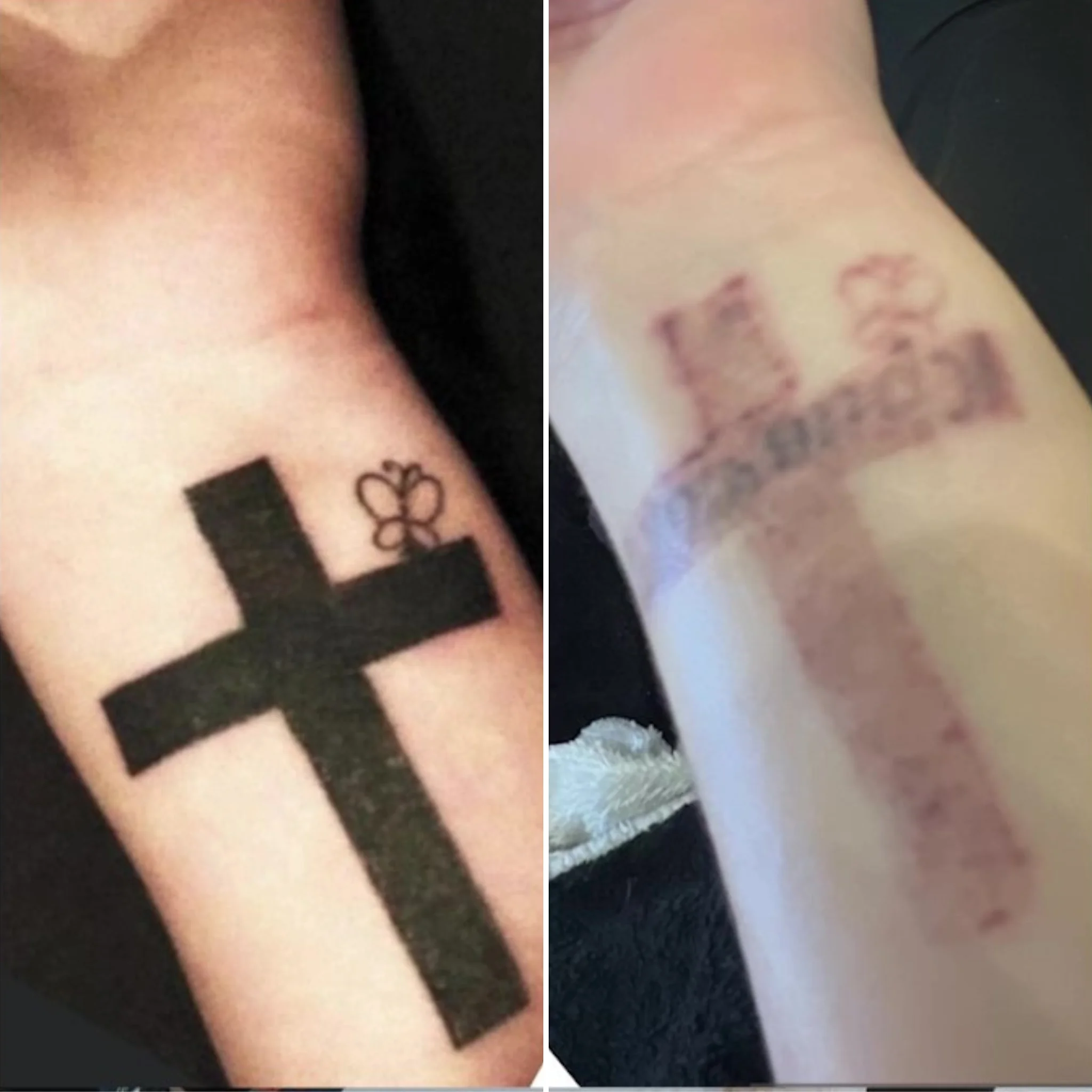 Tattoo Removal(3)