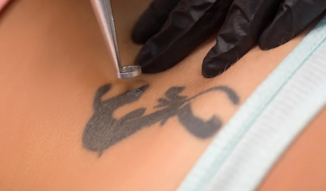 Tattoo Removal Etobicoke