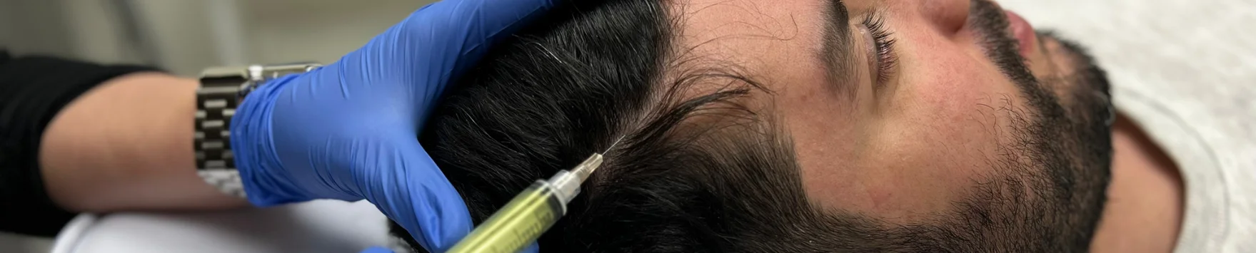 PRP Hair Restoration with Biotin
