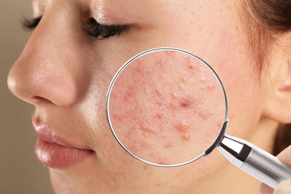 LASER ACNE FACE TREATMENT