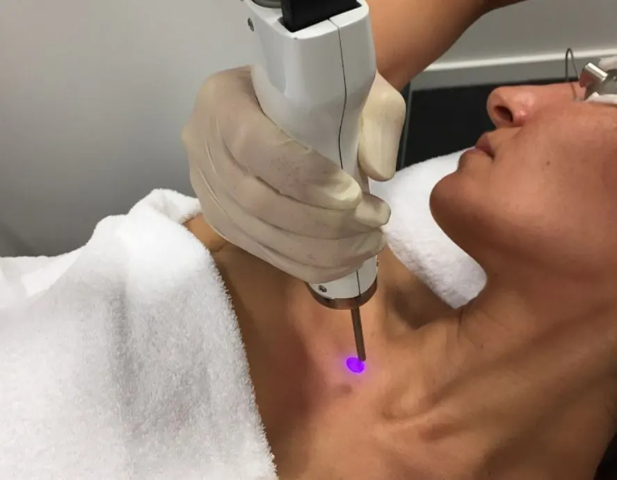 LASER PIGMENTATION REMOVAL  – Decolletage