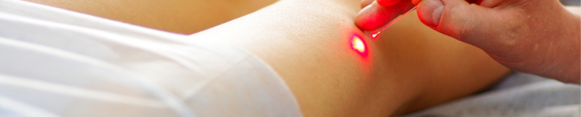 Laser Vascular Vein Removal – Small Area