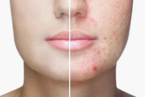 LASER ACNE FACE TREATMENT