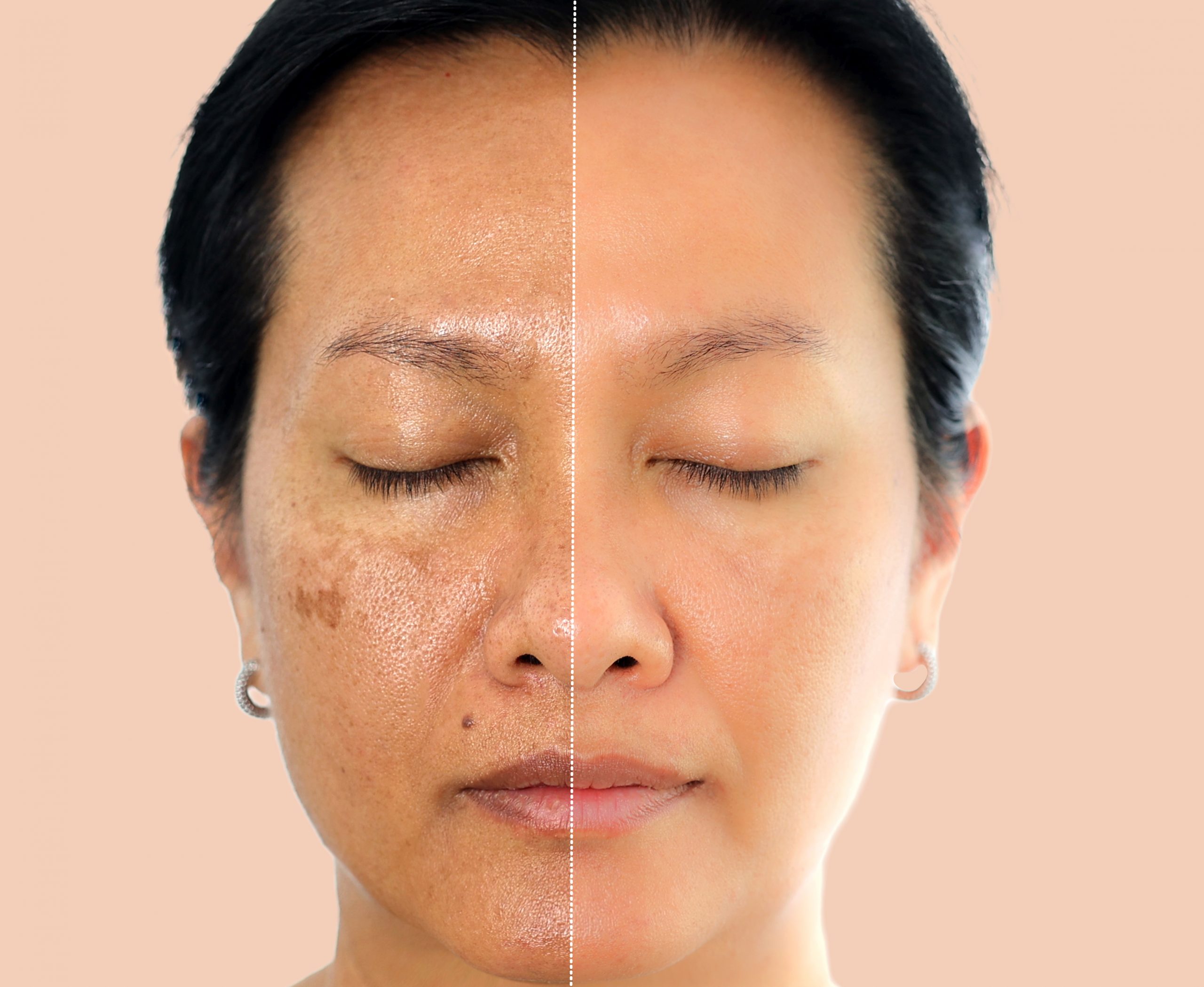 LASER PIGMENTATION REMOVAL – Large Area