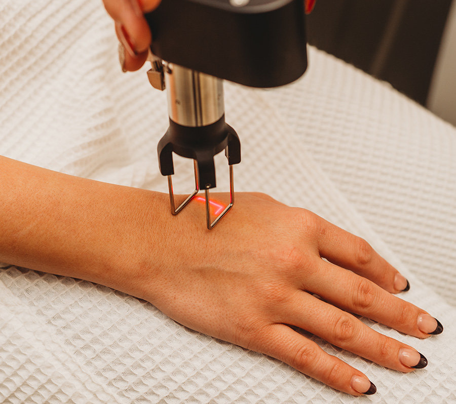 CoolPeel Laser Treatment – Hands