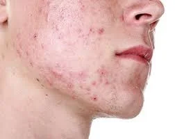 LASER ACNE FACE TREATMENT