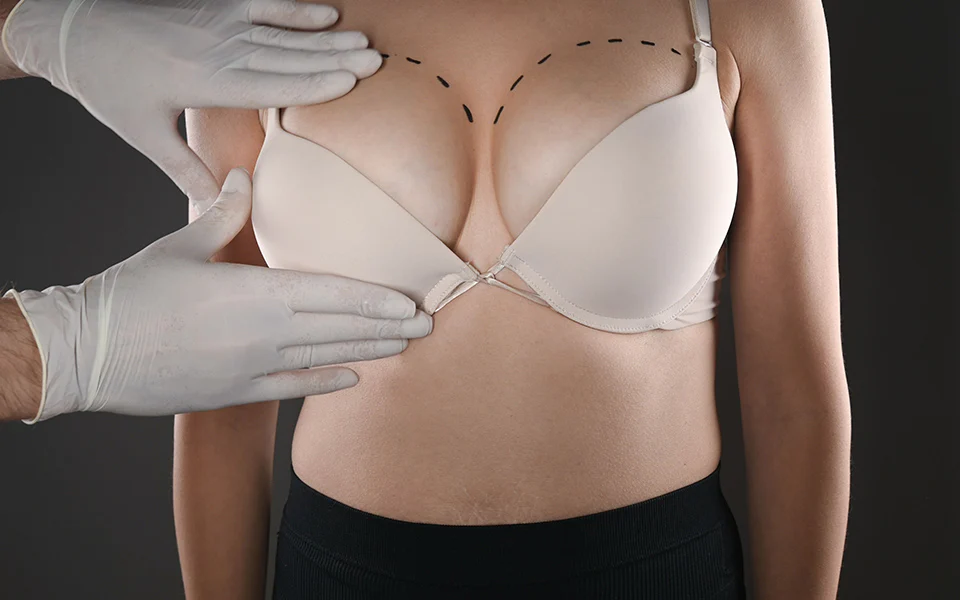 Microneedling for Breast