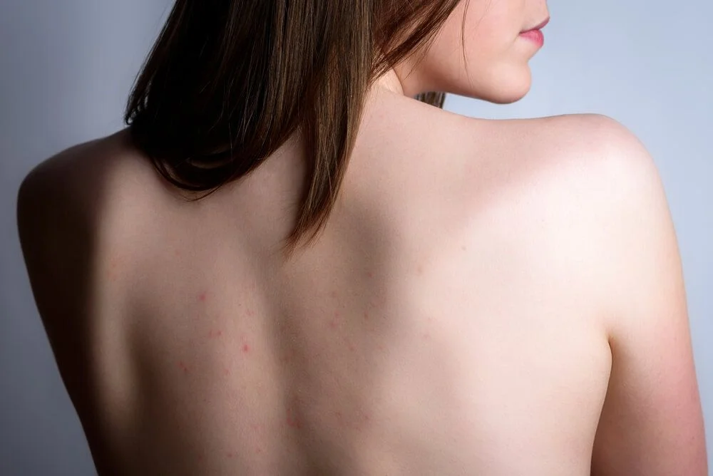 LASER ACNE BACK TREATMENT