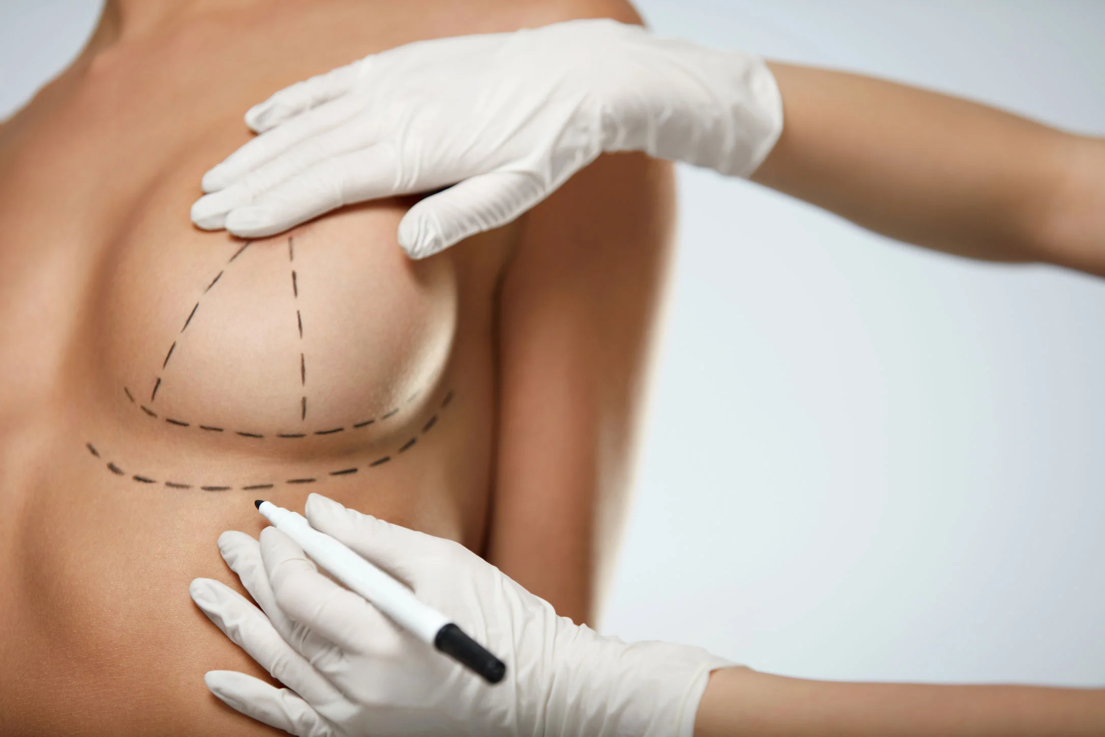 Microneedling for Breast
