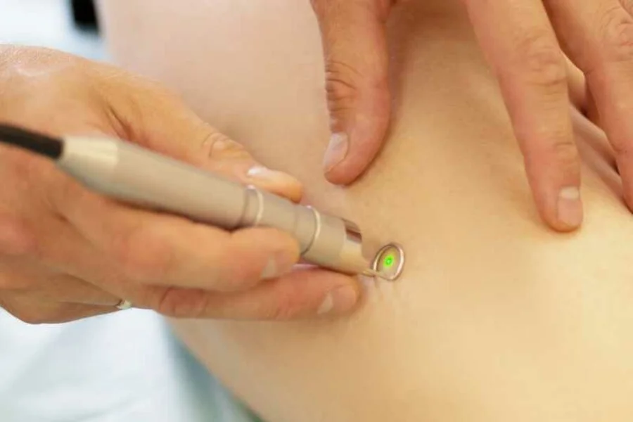 Laser Vascular Vein Removal – Medium Area