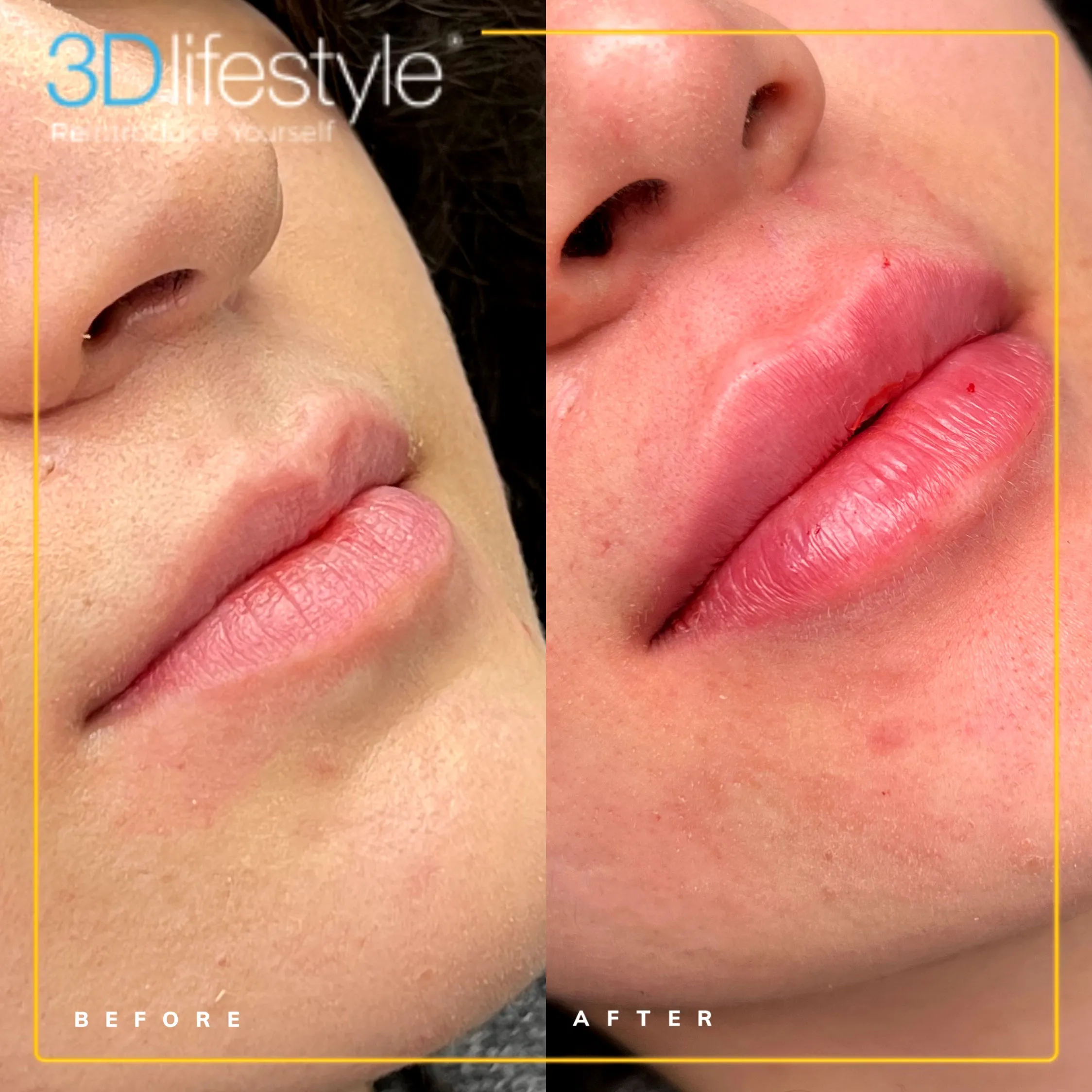 Before after - Lip Fillers