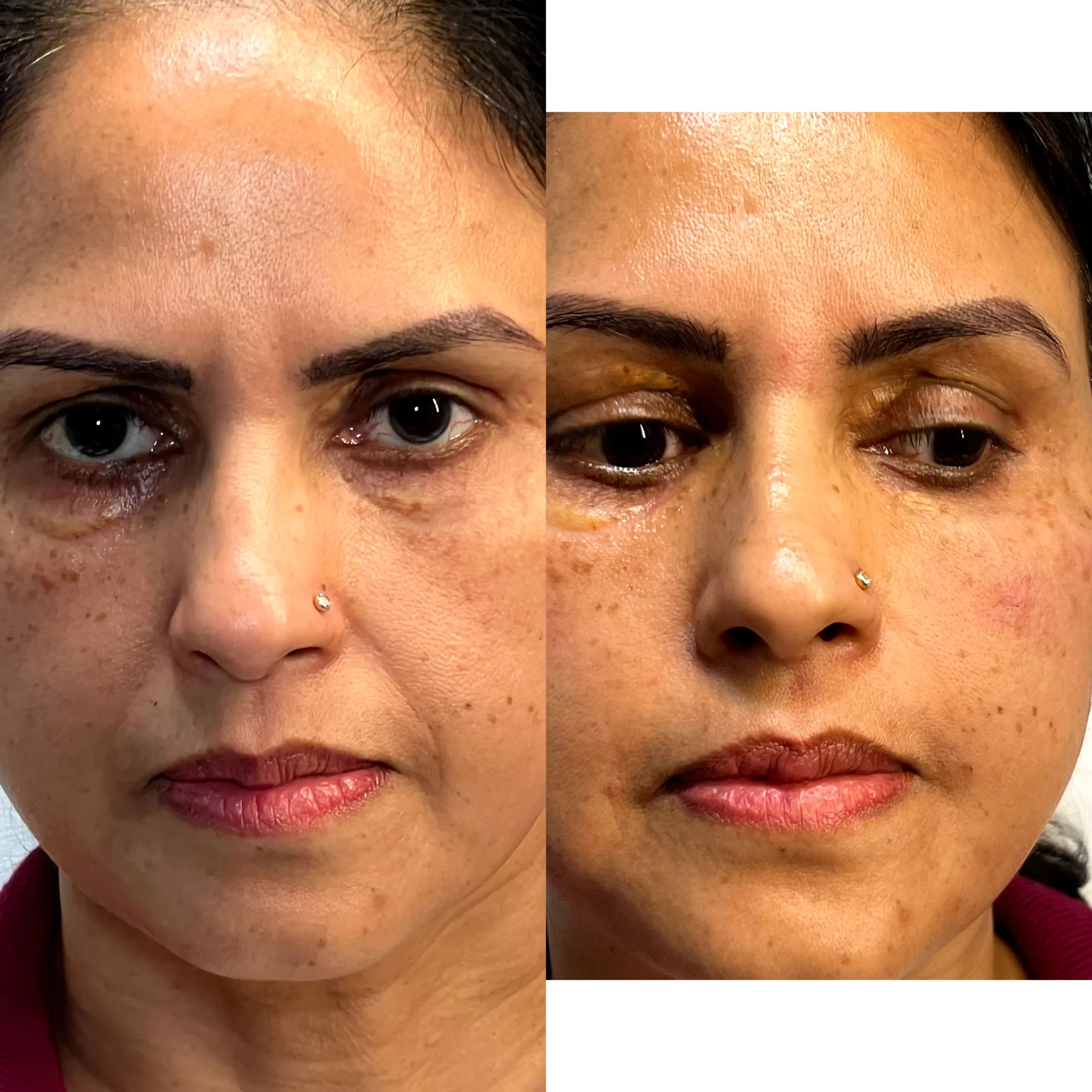 before after Nasolabial folds (smile lines) botox