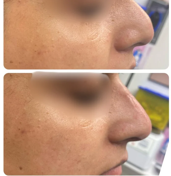 Liquid Rhinoplasty with Fillers