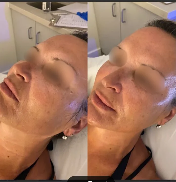 Liquid Rhinoplasty with Fillers