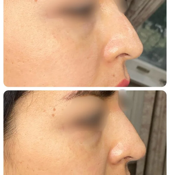 Liquid Rhinoplasty with Fillers