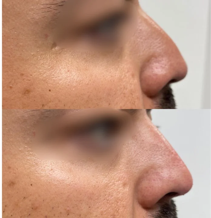 Liquid Rhinoplasty with Fillers