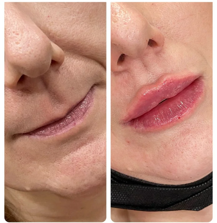 Dermal Fillers