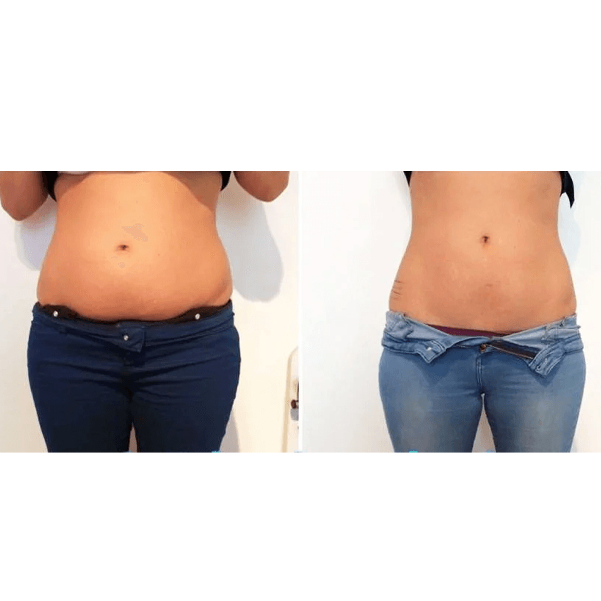 Body Contouring Toronto