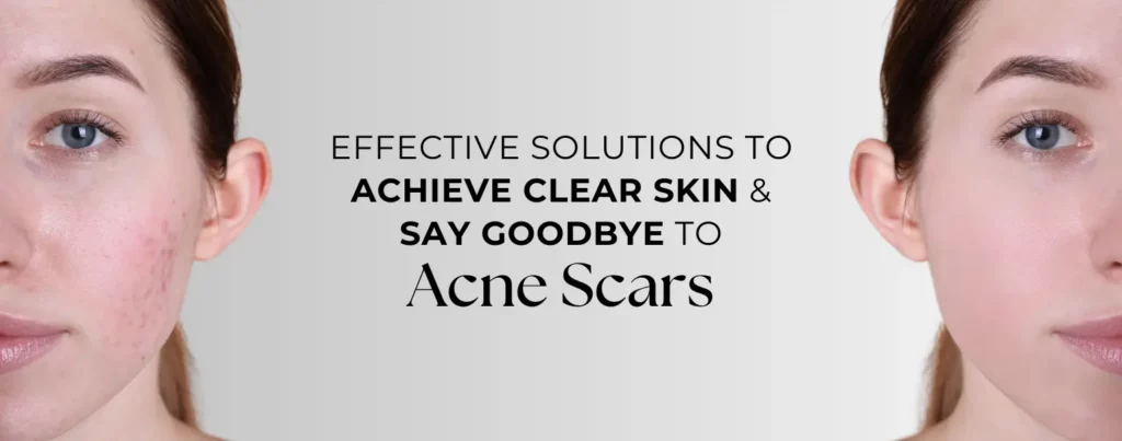 acne scars