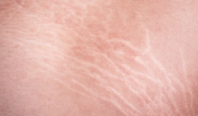 Stretch Mark Removal