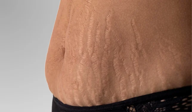 Stretch Mark Removal