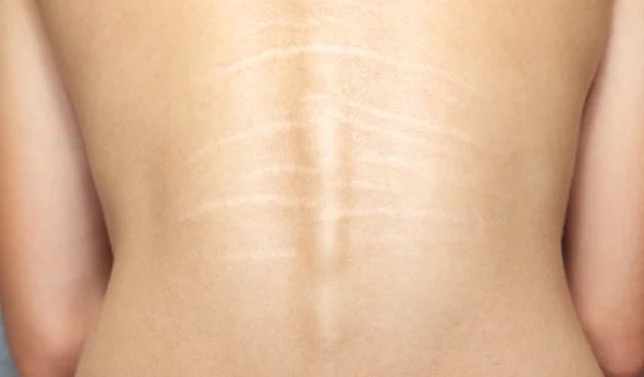 Stretch Mark Removal