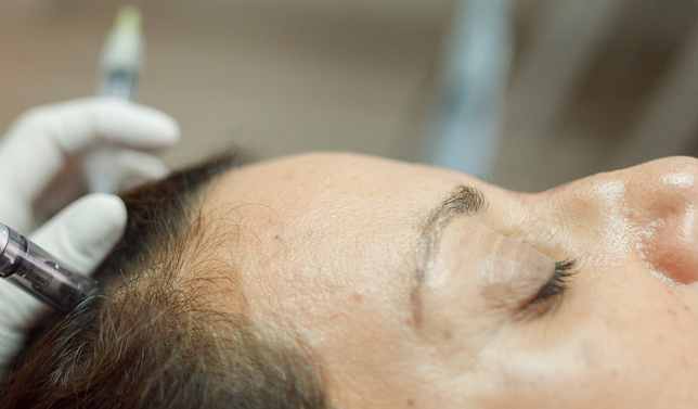 Microneedling + Exosomes/PDRN (Hair)