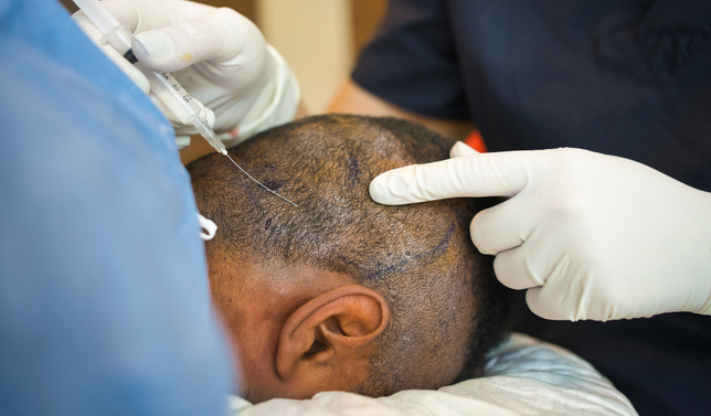 Microneedling + Exosomes/PDRN (Hair)