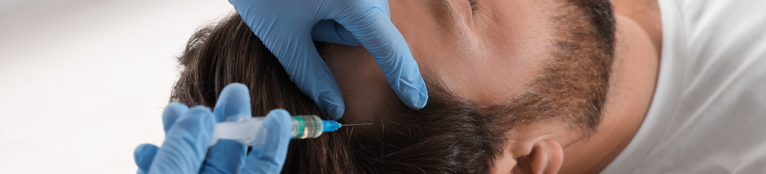Microneedling + Exosomes/PDRN (Hair)