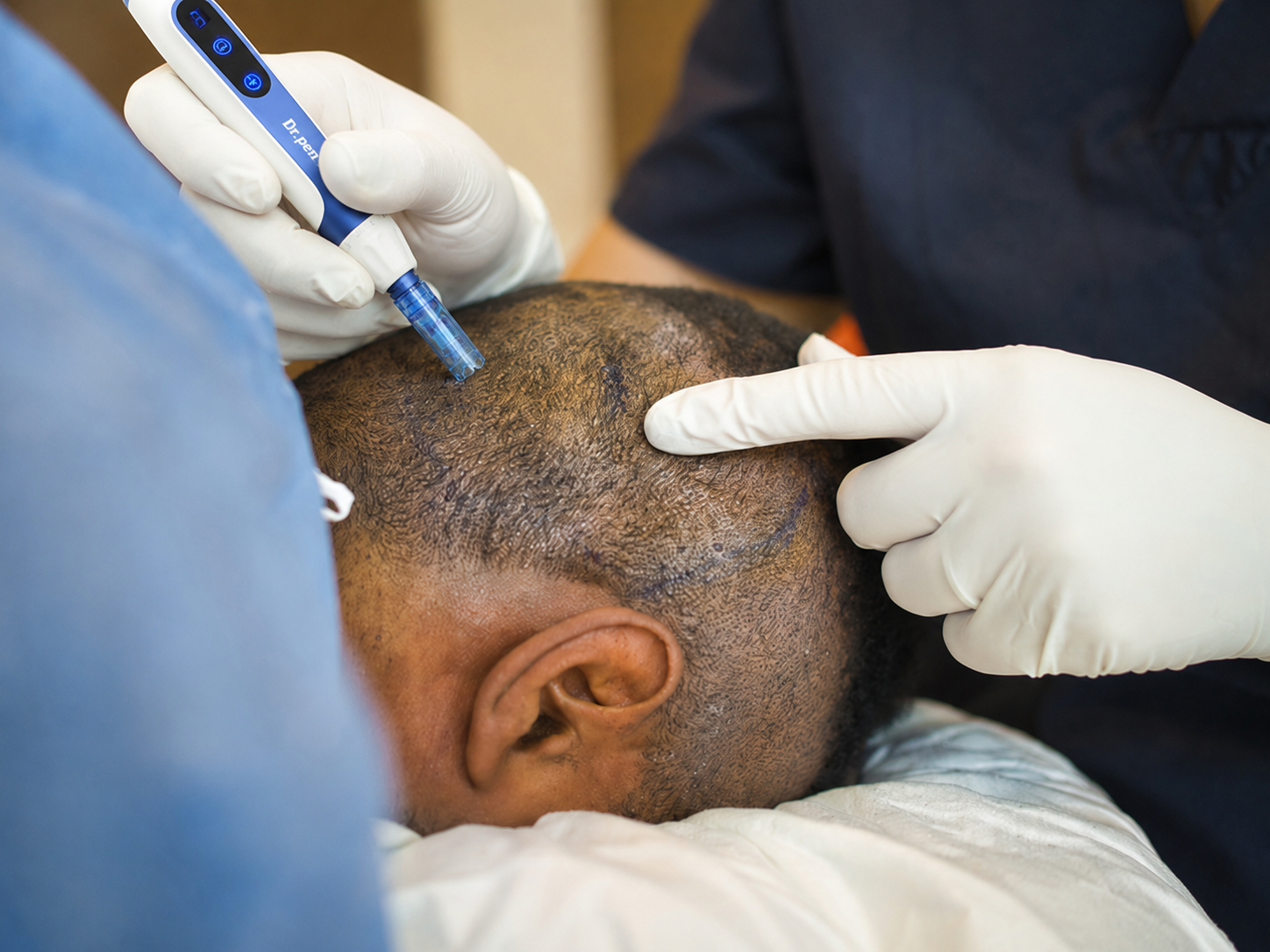 Microneedling With Exosomes for Hair Regeneration