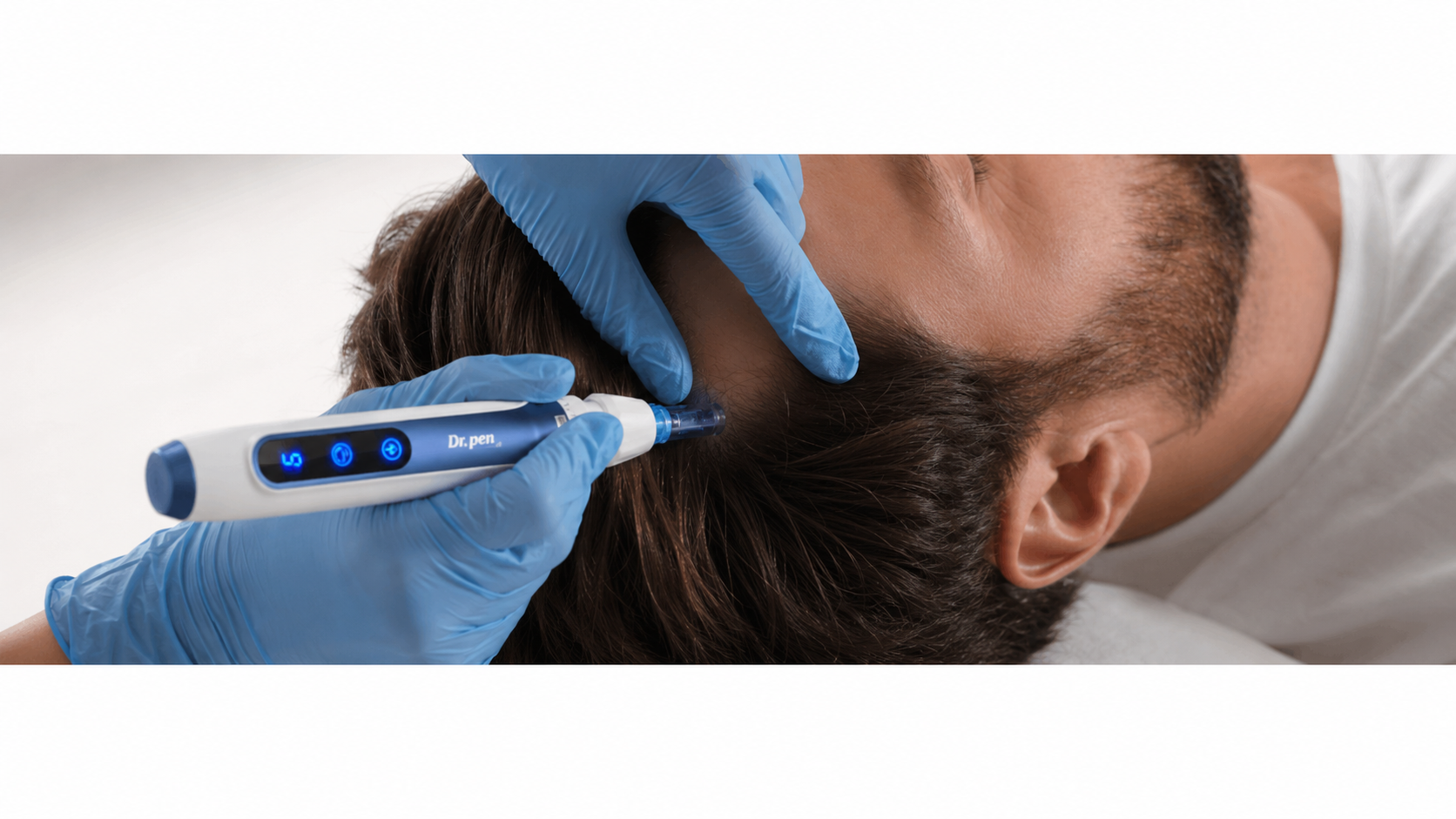 Microneedling With Exosomes for Hair Regeneration